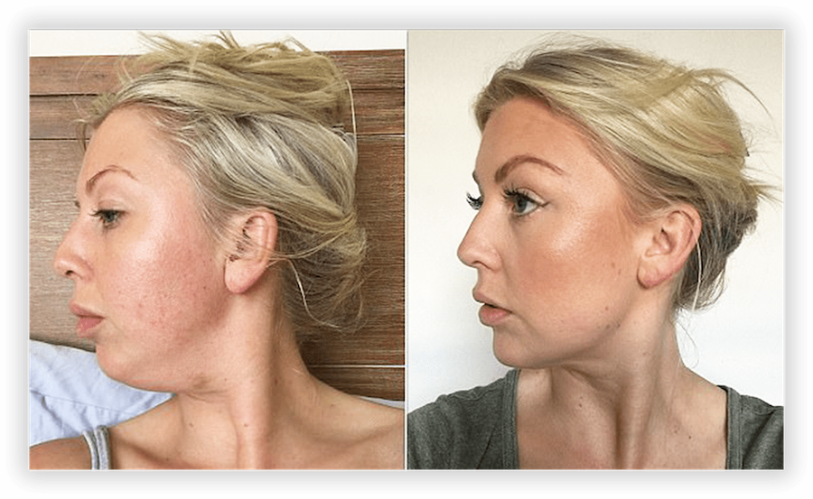 Non Surgical Facelift 2